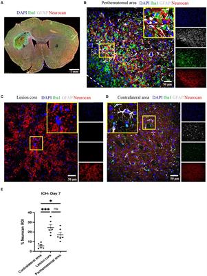 Prominent elevation of extracellular matrix molecules in intracerebral hemorrhage